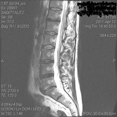for 1 grade exercises retrolisthesis Non Out of Options Running Surgical